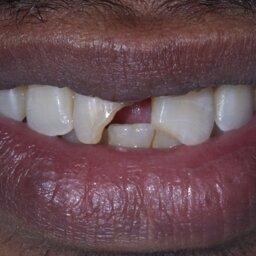 Restoring smiles with direct composite restoration