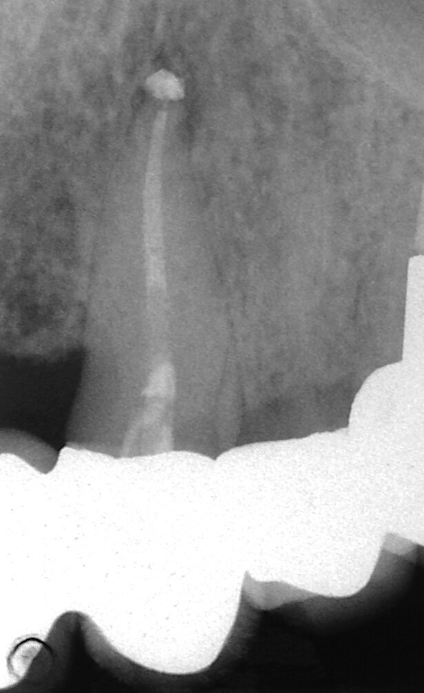 Fig. 3e: (a) Radiolucency in the cervical part of the canine. (b) Bleeding from the perforation. (c) MTA application with the MAP System and PD MTA White. (d) Original canal and repair of root perforation. (e) Post-op radiograph showing the root canal filling.