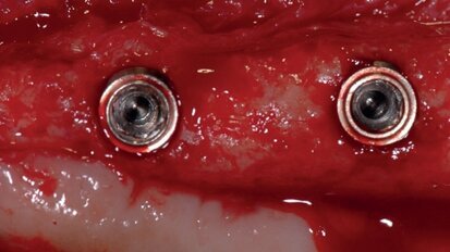 Histomorphometric analysis of bone healing at implants with turned or rough surfaces: An experimental study in the dog