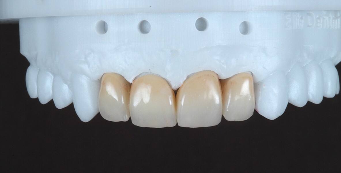 Fig. 10: Final restorations on the model after surface finishing and polishing as well as glazing.