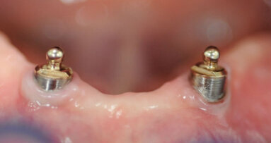 Riabilitazione di paziente già portatore di protesi con overdenture su due ball attachment preesistenti e usurate