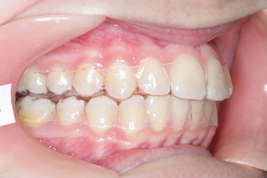 Fig. 15: Intermediate stage of Reveal aligners.