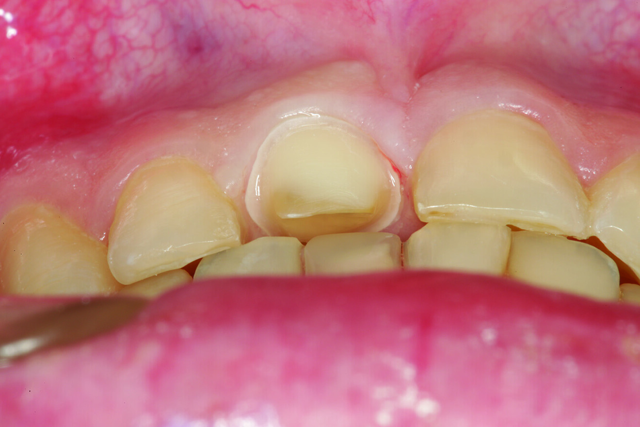 Fig. 10: Inferior view of tooth #11 after preparation and with the teeth in maximum intercuspation. Note how the restoration of tooth #41 was needed to position the incisal edge and facial surface in a more lingual position to allow for the space required to restore the palatal surface of tooth #11 at the proper thickness while maintaining the natural palatal concavity determined in part by occlusal excursive patterns.
