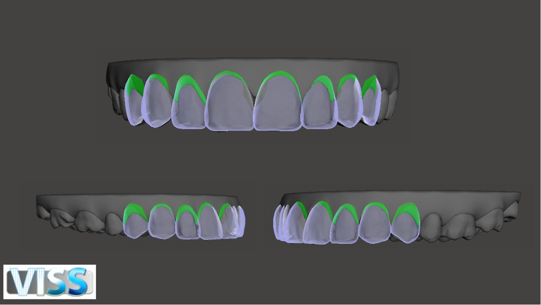 Fig. 45: A second option presented to the patient showing soft-tissue recontouring of the two maxillary lateral incisors for comparison.