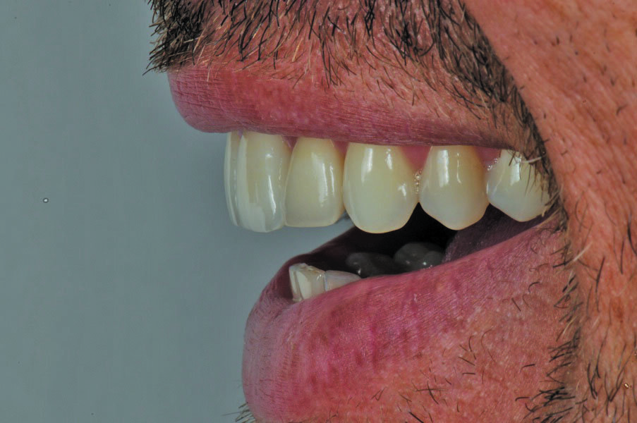 Fig. 21: Lateral view of a happy patient.