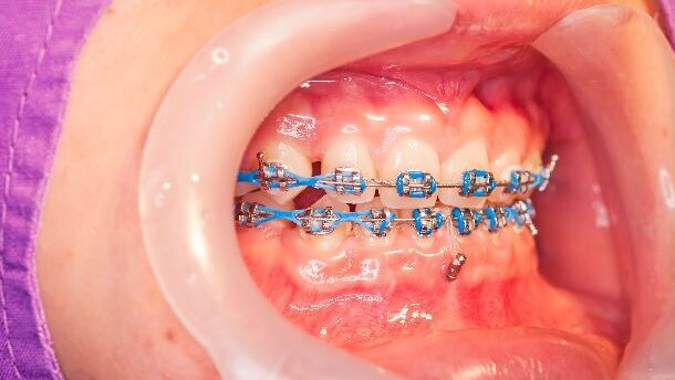 Tandartsen doen zich onterecht voor als orthodontist
