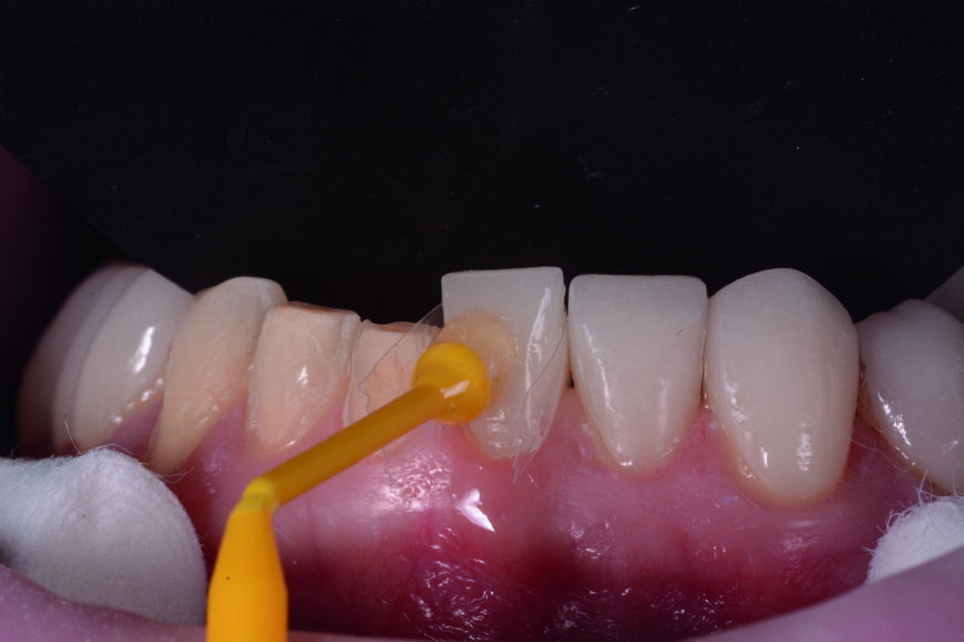 Figs. 11 et 12 : Les couronnes (11–13 et 21–23) et les facettes (14–17, 24–27, 31–37 et 41–47) sont collées sur les dents piliers avec une colle composite photopolymérisable (Futurabond U et Bifix QM).
