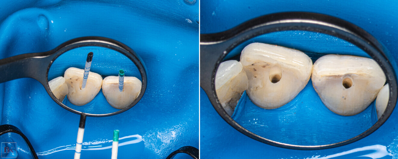 Figs. 19a & b: Drying the canal before obturation (a). The nal shape of the access cavity (b).