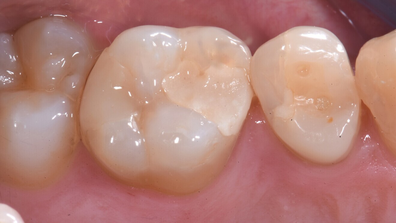 Fig. 9: Class II glass hybrid restoration five years after treatment. 