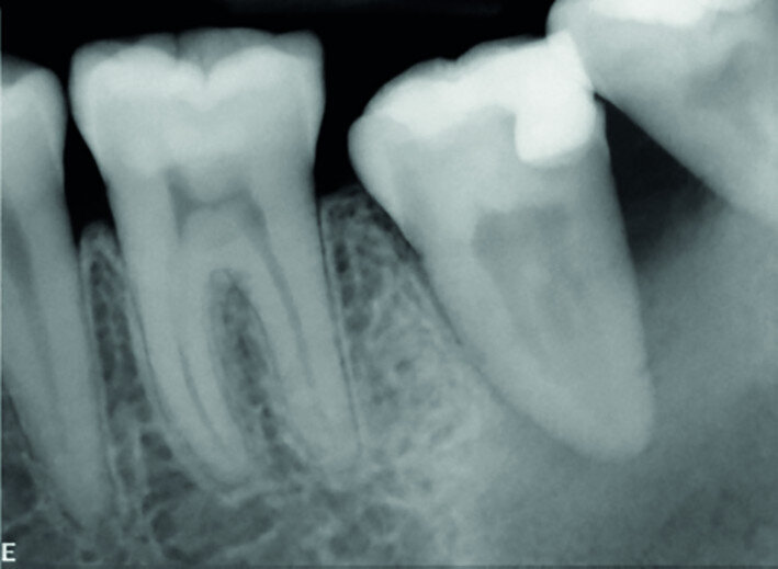 Fig. 15b: Radiograph: Immediately after transplantation.