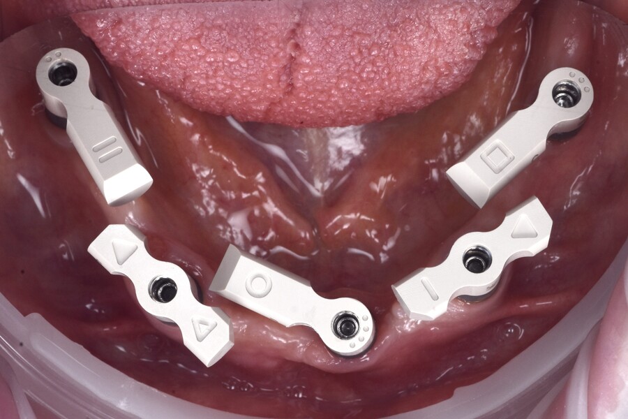 Figs. 11a & b: SmartFlag scan bodies (Apollo Implant Components) connected to the multi-unit abutments (a). Close-up photograph of the SmartFlag scan bodies (Apollo Implant Components; b).