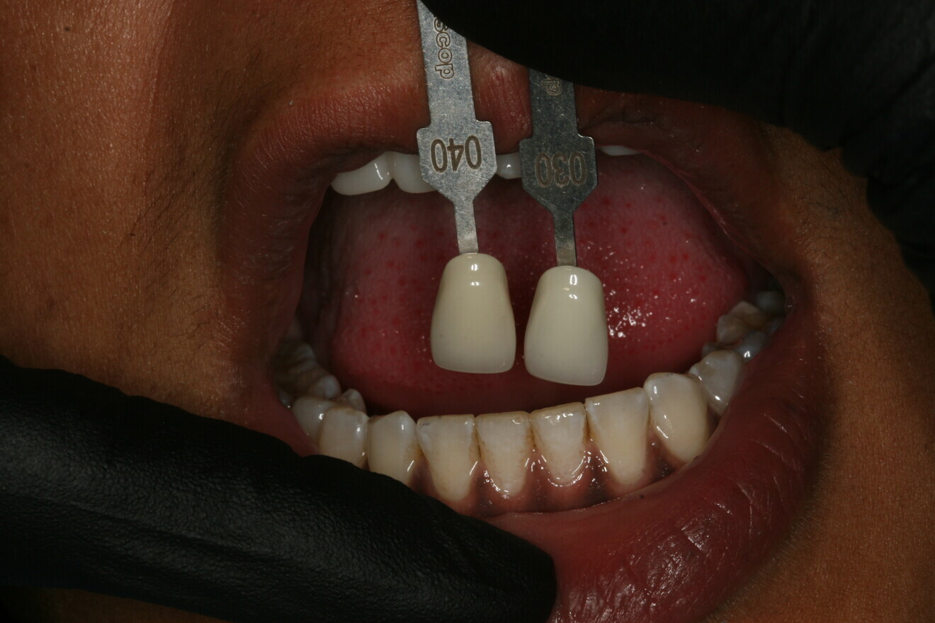 Fig. 5: Shade comparison with the opposing dentition.