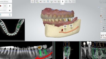 Implant Studio da 3Shape é autorizado para vendas pela autoridade sanitária americana