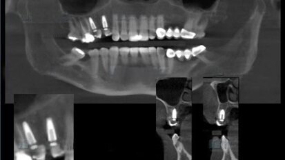 Colocación de implantes con LOCimplant System