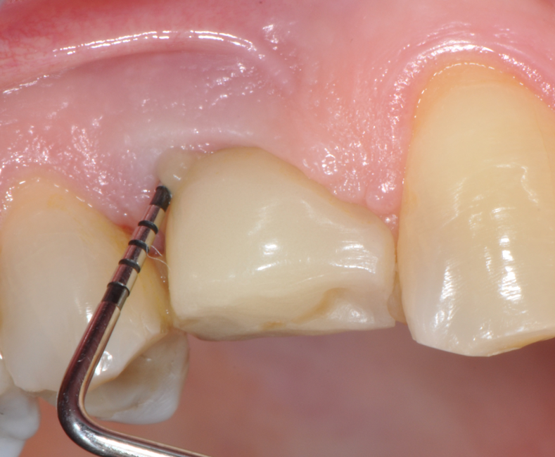Fig.1: Case 1. Peri-implant probing reveals a PPD of 9mm and pus.