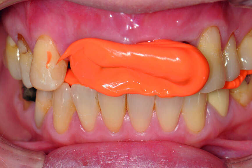 Fig. 32: ICP bite registration on the healing abutments.