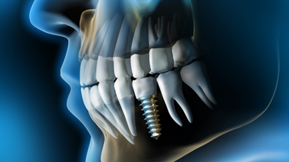 Schweizer Implantatmarkt im Umbruch?