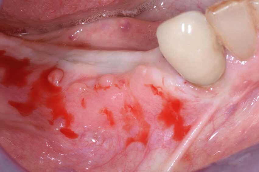 Fig. 9a - La cresta a 6 mesi di distanza.