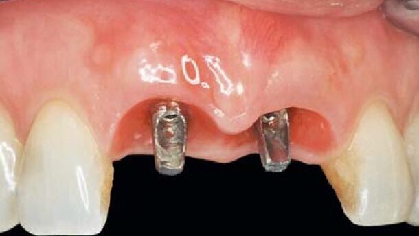 Czy recesja tkanki miękkiej wokół implantów wciąż jest nieunikniona? – część 2