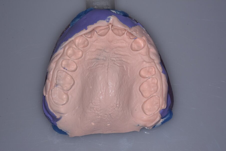 Fig. 4_Doppia impronta con Hydrorise Implant putty e light.