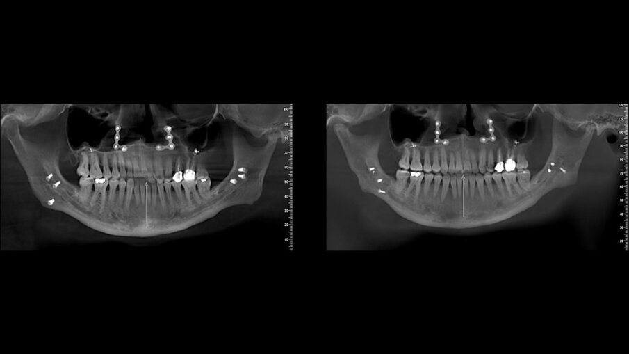 Fig. 12_Le due viste panoramiche CBCT prima e dopo il percorso terapeutico a confronto, con evidente riduzione della testa del condilo destro.