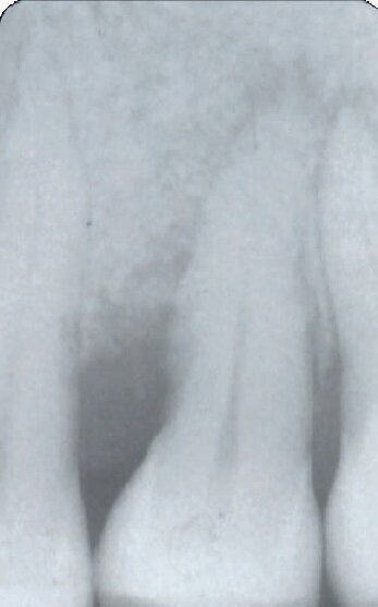 Fig. 13b - Rx a 1anno.