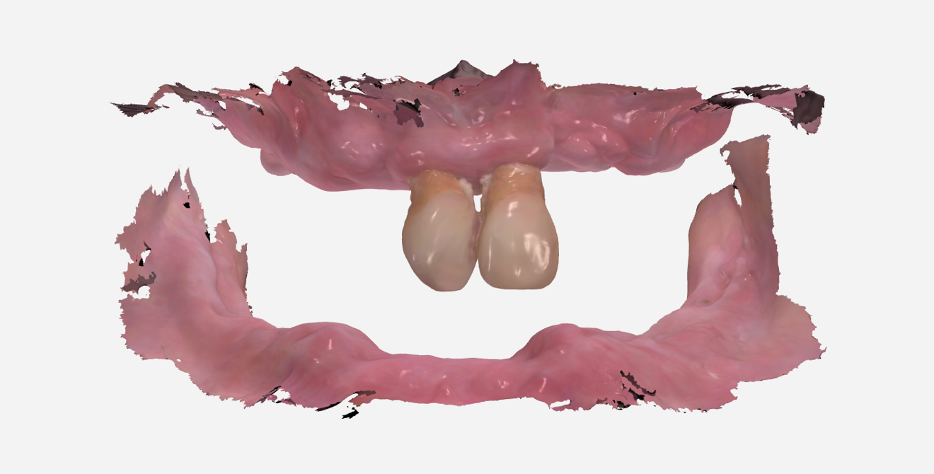 Fig. 1: Intra-oral scan of the initial situation, showing the jaws in relation.