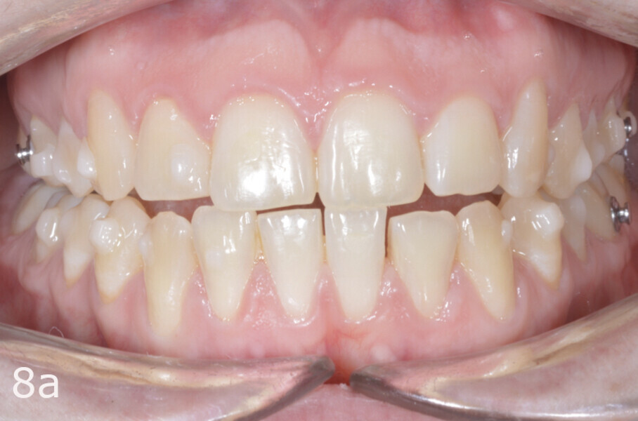Figs. 8a–d: Situation after aligner set 40. Thanks to the use of a Class III elastic on the right, the dental midlines were improved.