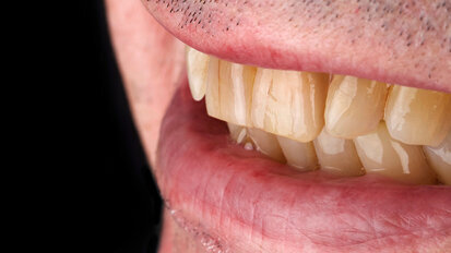For age-appropriate esthetics: Natural effects with VITA VM materials