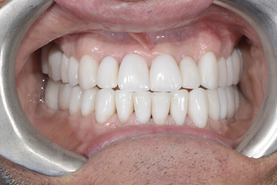 Fig. 27h: Underbite view.