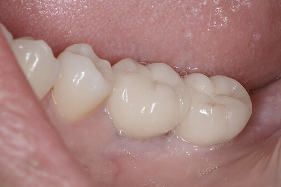 Fig. 16 : Aspect clinique de la zone des tissus mous péri-implantaires après la mise en charge des restaurations définitives. 