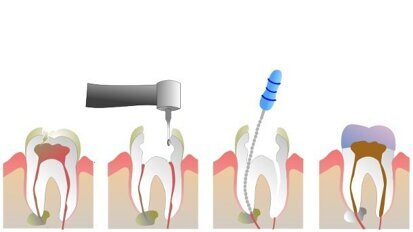 Une nouvelle procédure dentaire pourrait remplacer le traitement endodontique