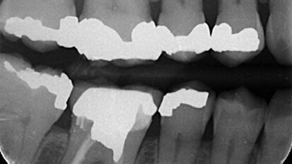 Managing maxillary molars
