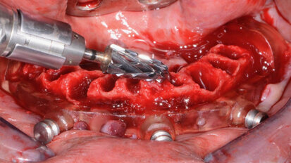Overdenture solutions for today’s economy
