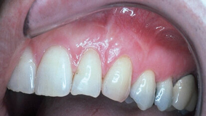 Cosmetic periodontal surgery: Multiple gingival graft techniques (Part 2)