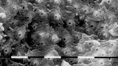 Laser in endodontics (Part II)