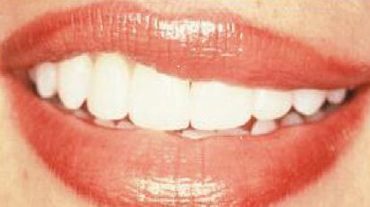 STA: essential for cosmetic dentistry