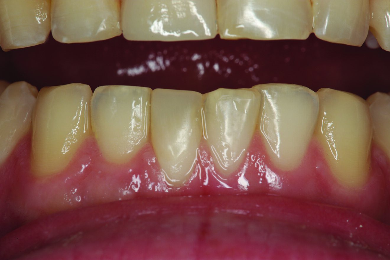 Fig. 8: Tooth #41 shown from the facial aspect after restoration of the facial surface and the incisal edge.