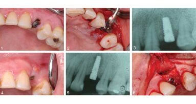 Guided bone regeneration treats implant lesions