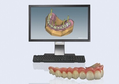 Ceramill M-Gin