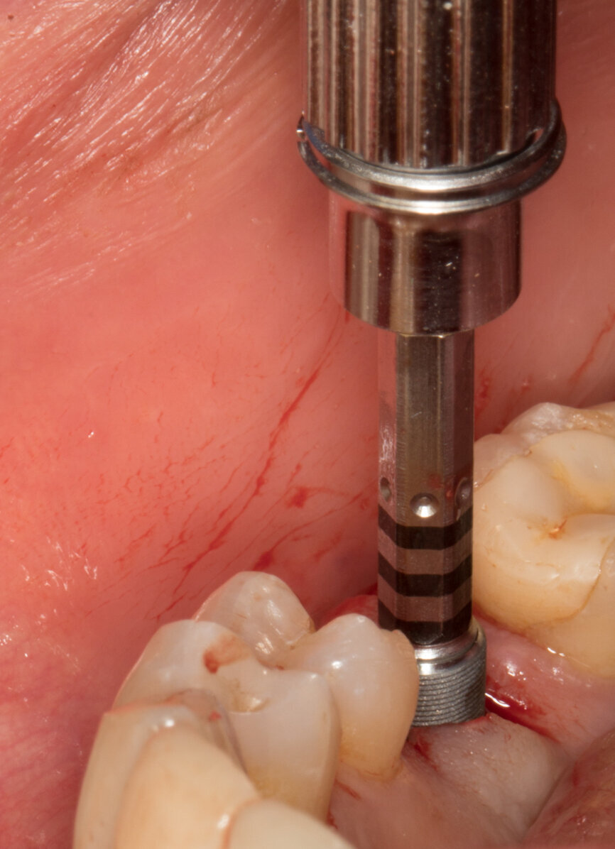 Ryc. 13_Wprowadzenie implantu.

