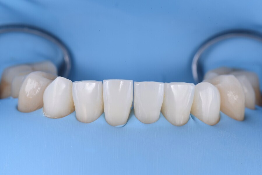 Fig. 7a-d: Direct composite restoration of the mandibular anterior sextant.