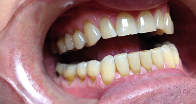 Research examines link between tooth wear management and quality of life