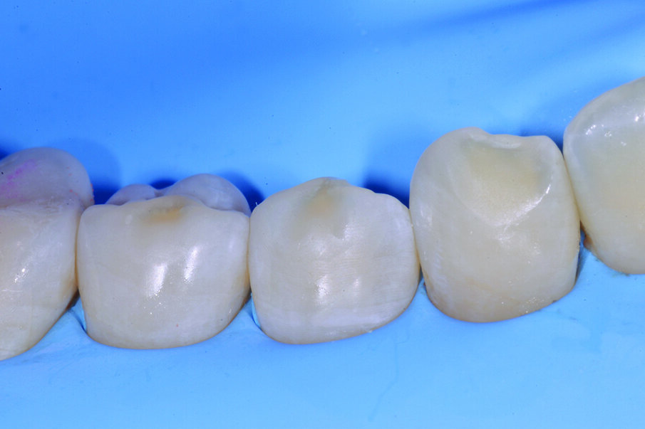 Figg. 6-9_Le superfici occlusali erose e/o abrase vengono ricostruite con strati sottili di smalto composito Enamel Plus HRi Bio Function. 
