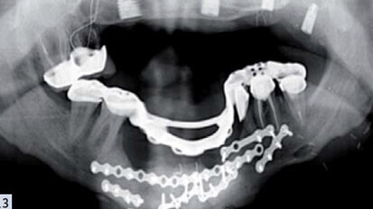 ADF 2015 : Implants et prothèse amovible partielle, un mariage de raison ?