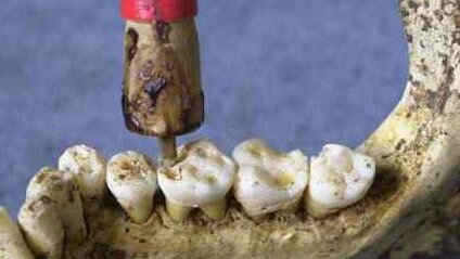 Un jet pour remplacer la fraise du dentiste