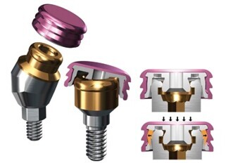GPS abutments for overdentures
