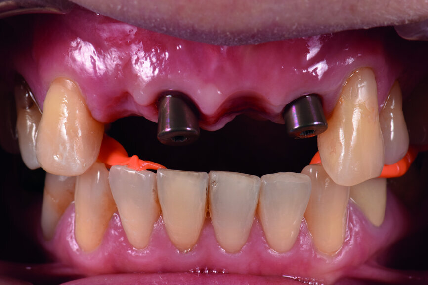 Fig. 31: Insertion of 5 mm healing abutments to obtain sufficient retention for the bite registration material. The same posterior ICP bite registration was used as for the provisional restoration in order to ensure the ICP was stable.