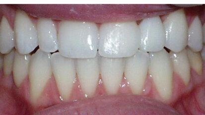 Dentists share their thoughts on veneers