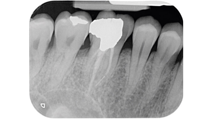 Fig. 1c_Foto iniziale, radiografia con cura canalare non ritrattabile, strumento rotto e probabile frattura verticale con sintomatologia da parte del paziente.